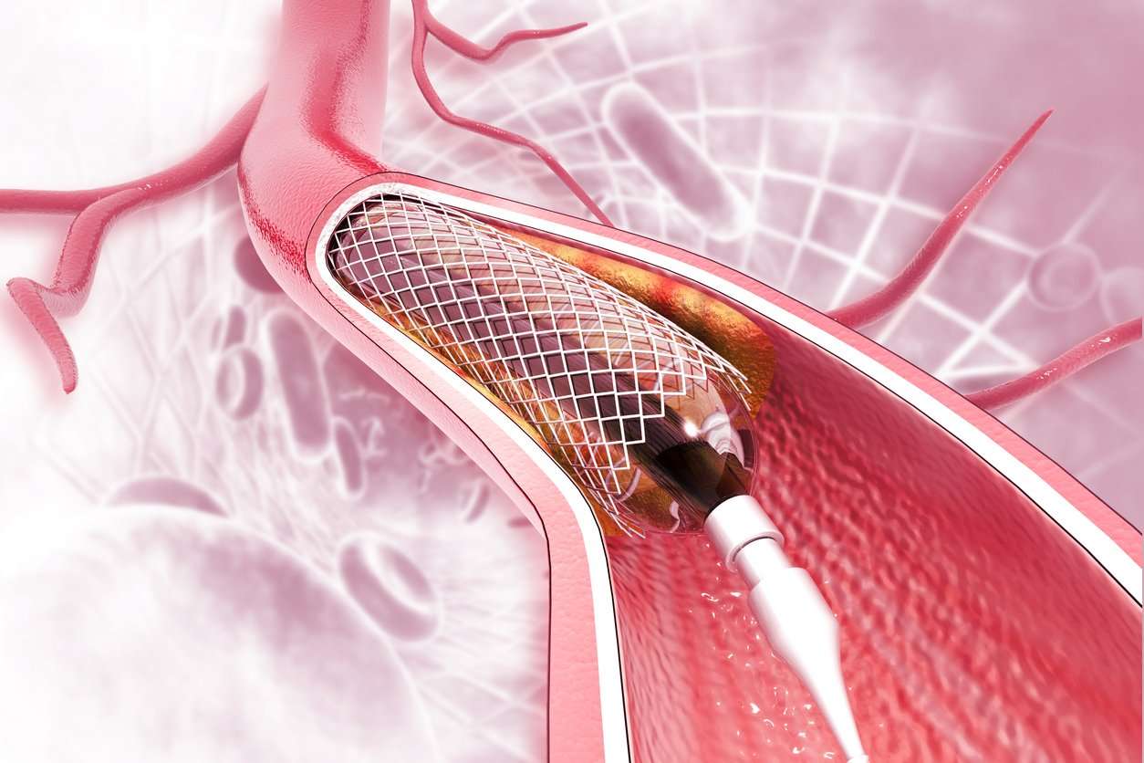 All About Cardiac Stents