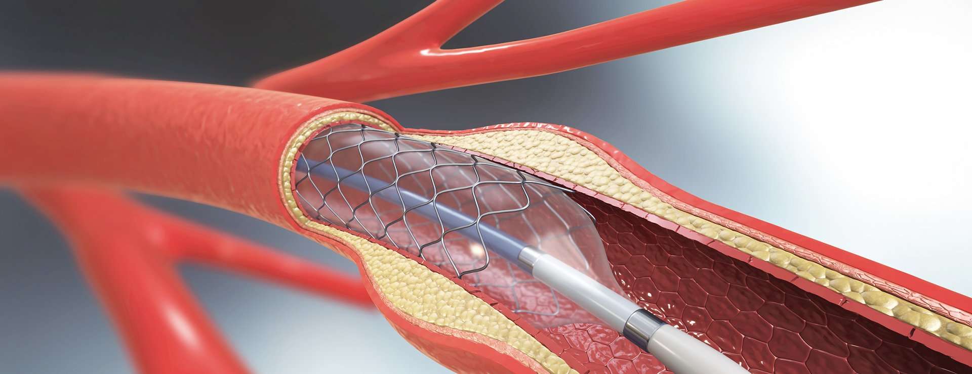 Angioplasty and Stent Placement for the Heart