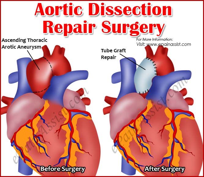 Aortic Dissection Repair Surgery