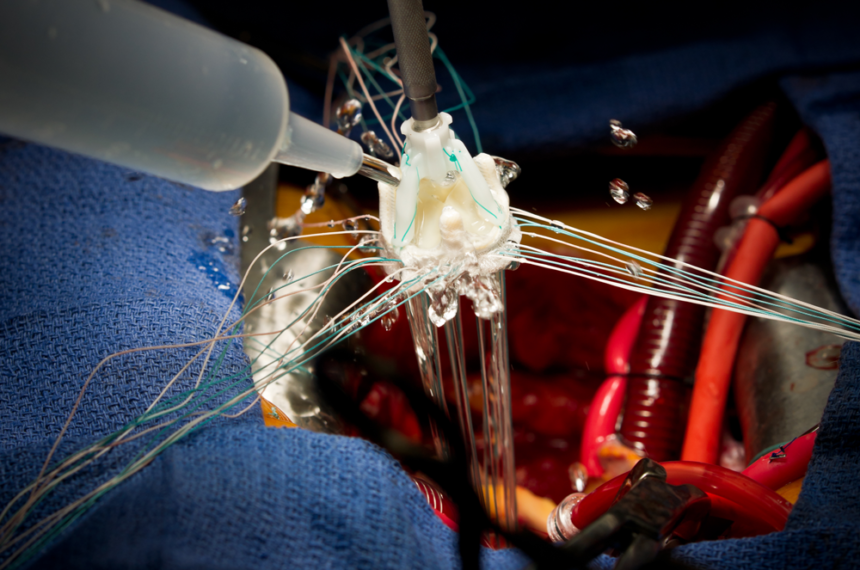 Aortic valve replacement linked to increased mortality in elderly ...