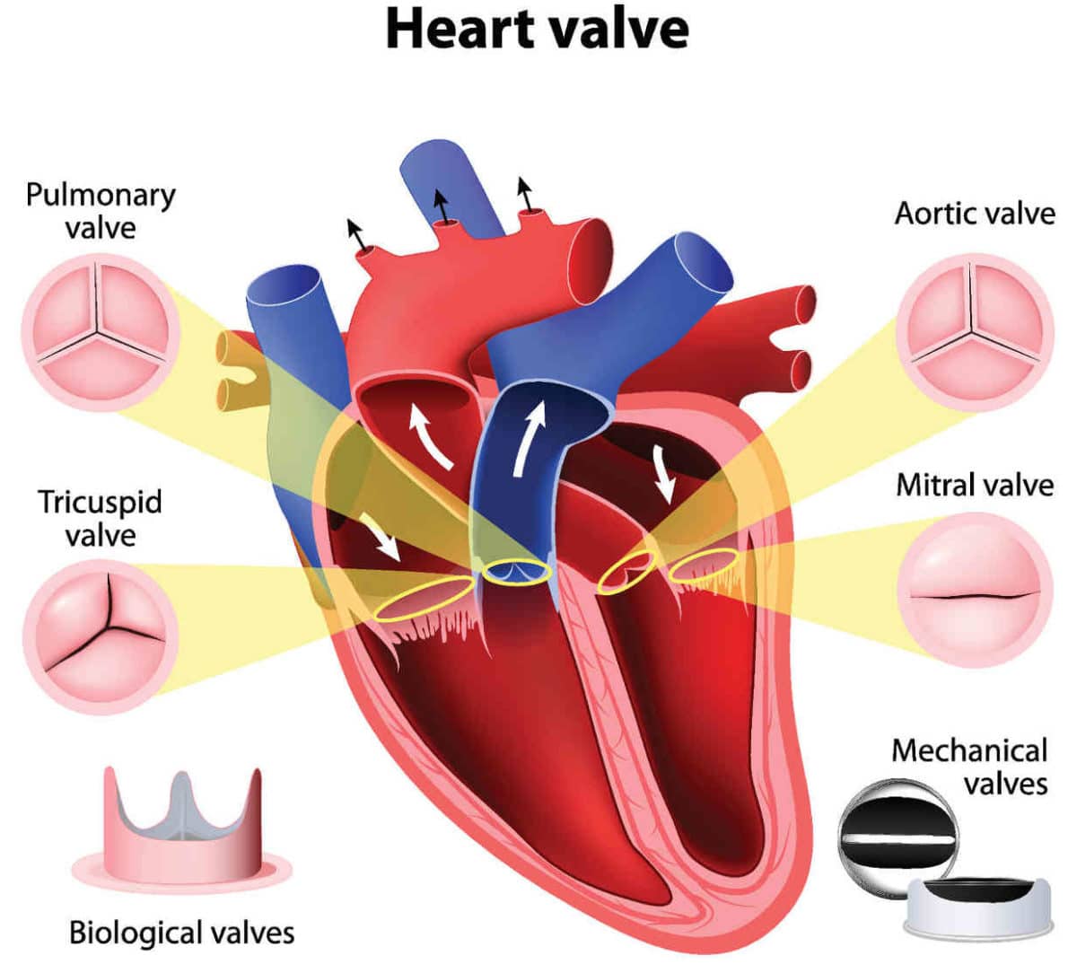 Aortic Valve Surgery, TAVR