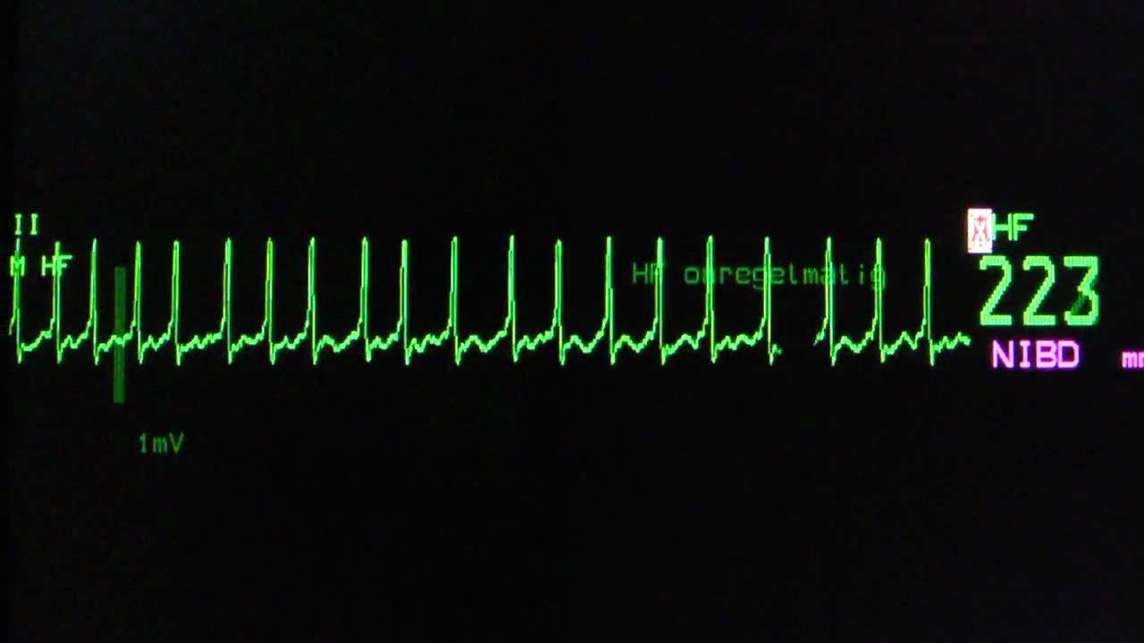 atrial fibrillation with rapid ventricular rate on an ECG ...