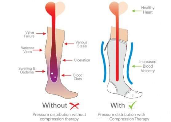 Benefits of Compression Hosiery