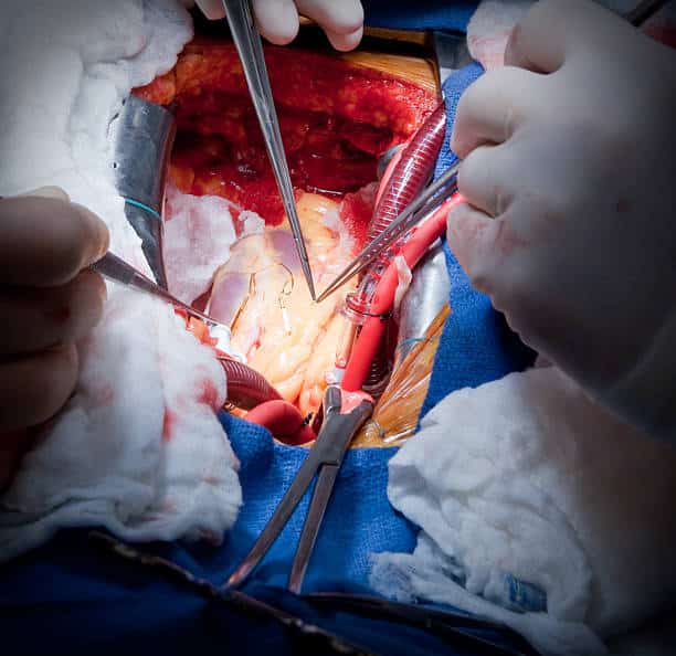 Best Heart Bypass Surgery Stock Photos, Pictures &  Royalty