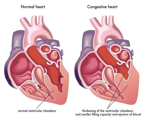 Causes and Symptoms of Exacerbating Congestive Heart ...