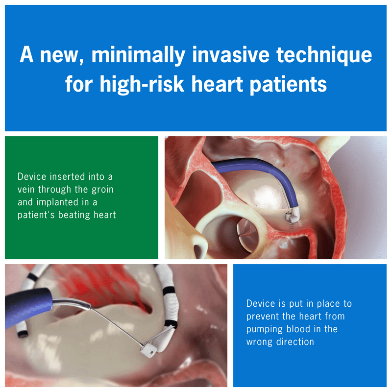 Cleveland Clinic Abu Dhabi Introduces Innovative Treatment for Heart ...