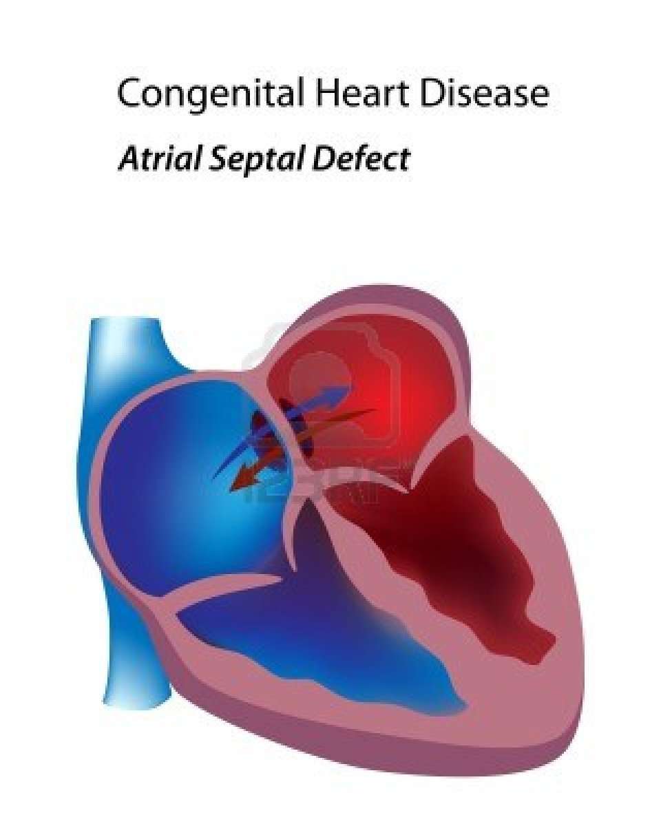 Congenital heart disease. Causes, symptoms, treatment ...
