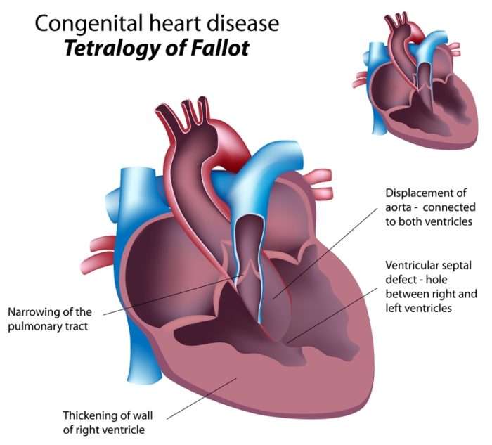 Congenital Heart Disease: How It Can Affect Us in ...