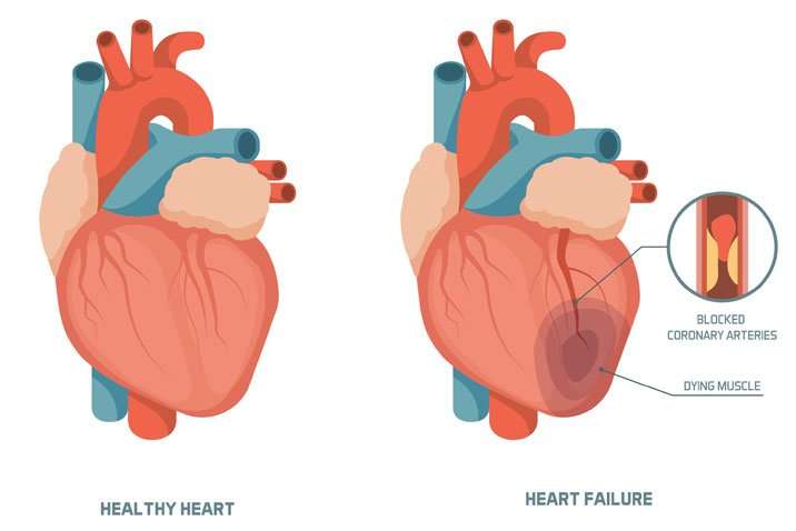 Congestive Heart Failure (Cardiac Failure)