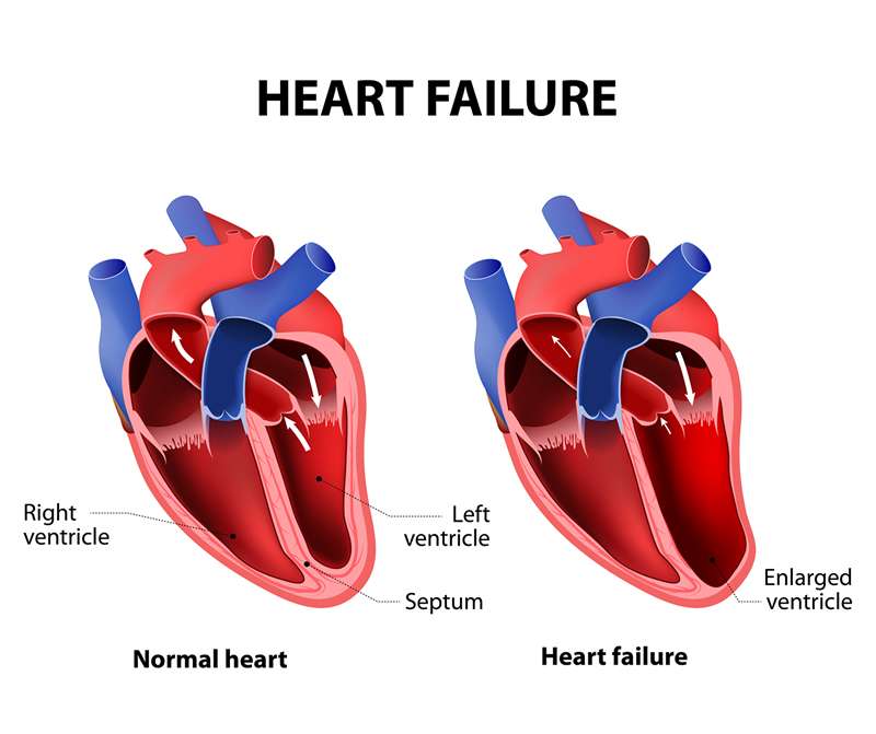 Congestive Heart Failure : Carolina Heart and Leg Center