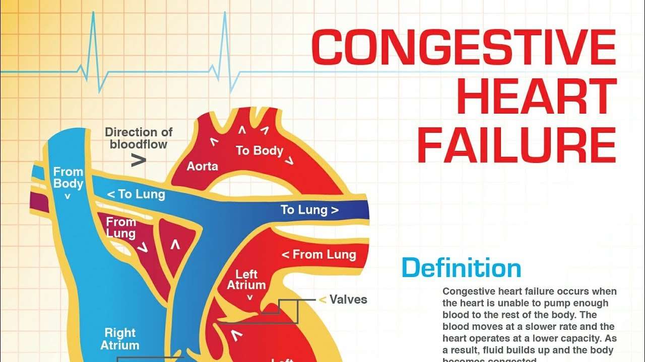 Congestive Heart Failure Definition
