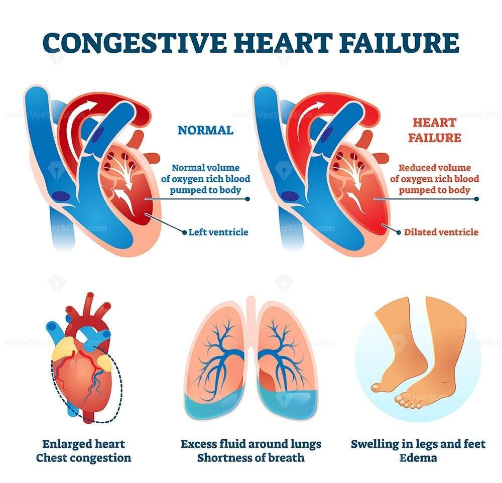 Congestive heart failure vector illustration