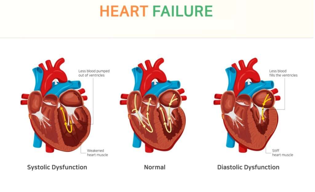 Diastolic heart failure: a failure to relax