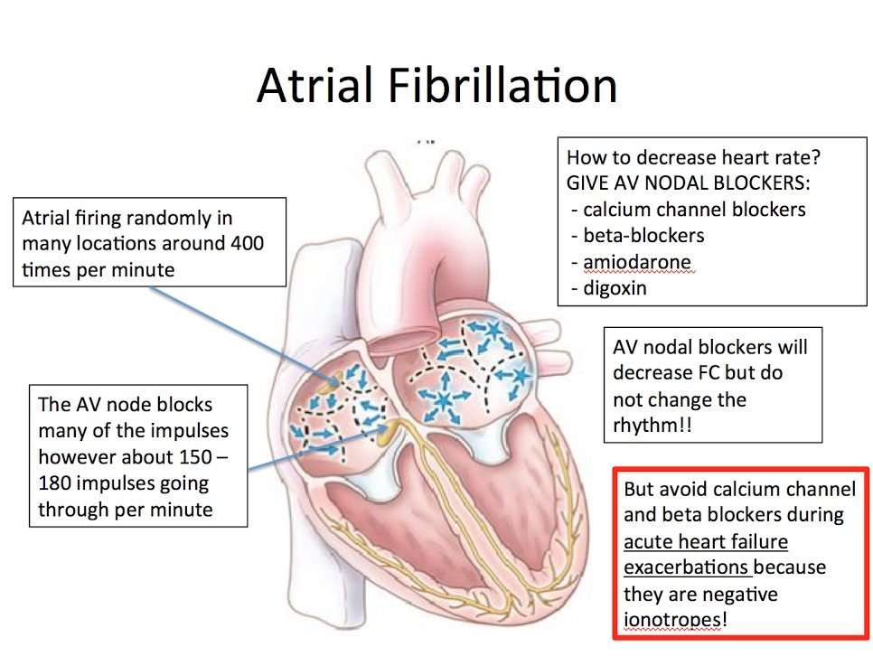 EKG â 2 â Atrial Fibrillation with Rapid Ventricular ...