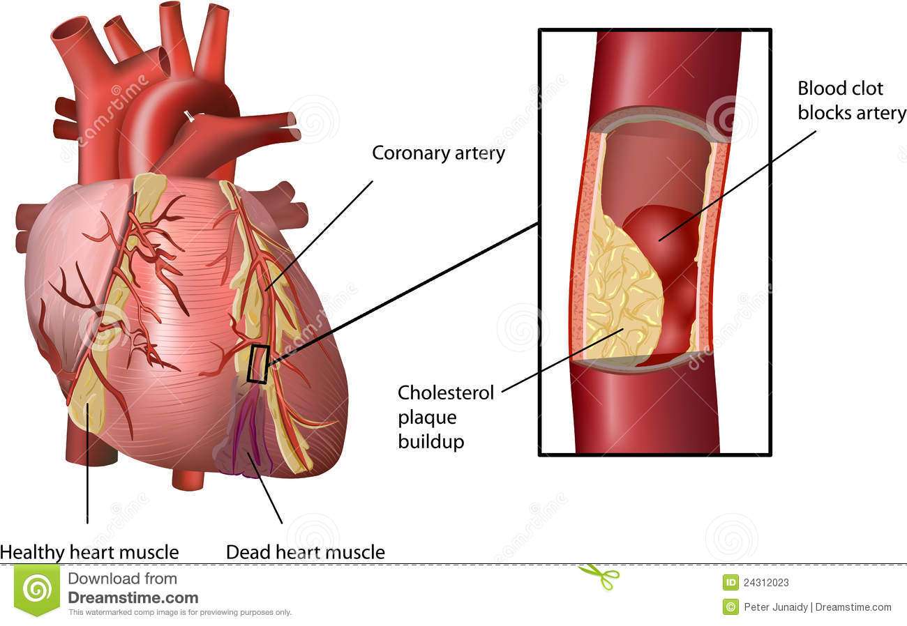 Heart Attack Caused by Cholesterol Stock Vector ...