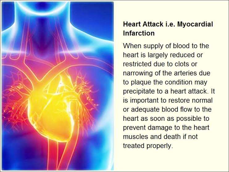 Heart Attack i.e. Myocardial Infarction