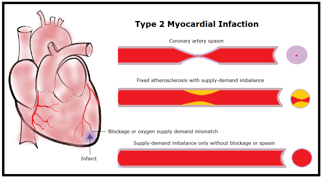 Heart attack types based on pathophysiologic mechanisms