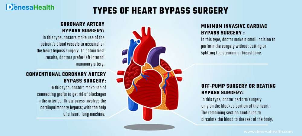Heart Bypass Surgery: Bypass Surgery Procedure &  Types
