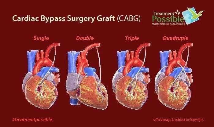 Heart Bypass Surgery in India
