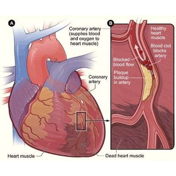 How Long Do Heart Attack Symptoms Last?