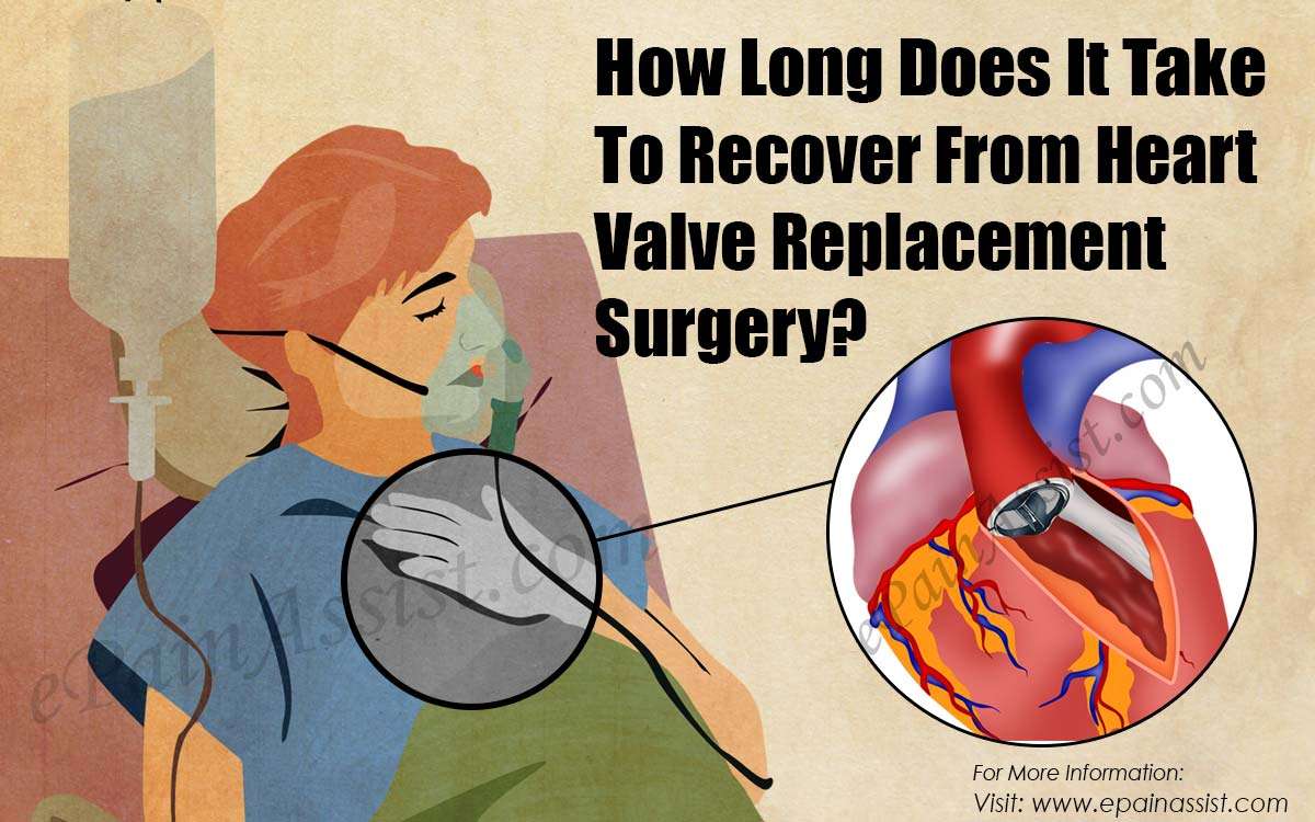How Long Does It Take To Recover From Heart Valve ...