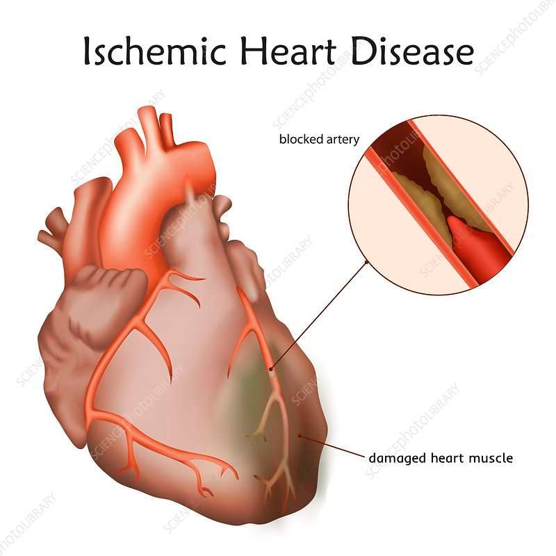 Ischemic heart disease, illustration