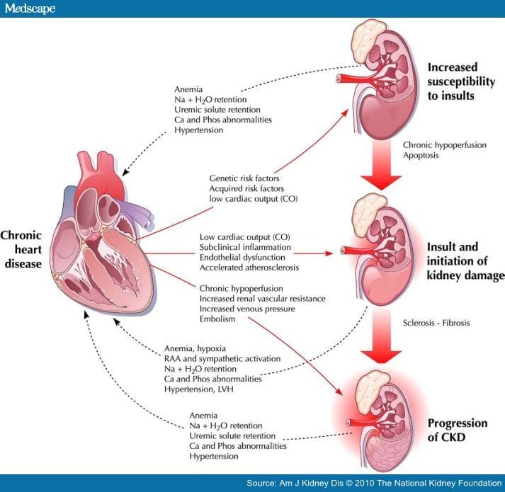 Kidney Failure Caused By Heart Failure
