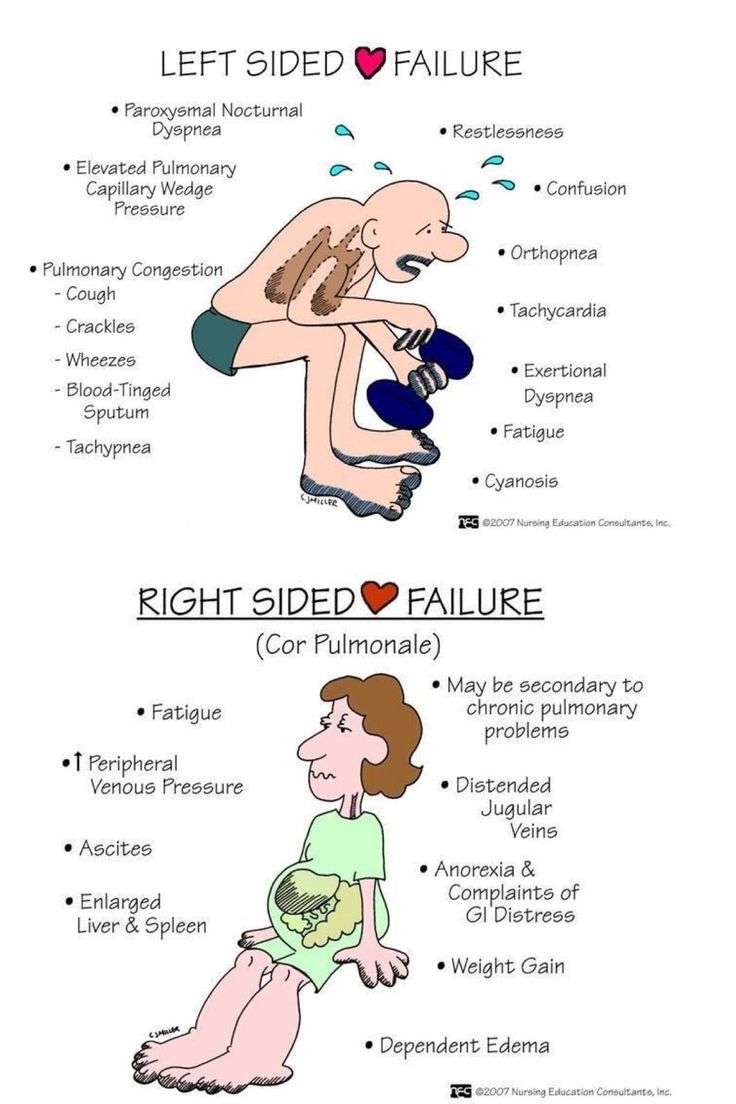 Left sided heart failure LVF and Right sides heart failure RVF #cardiac ...