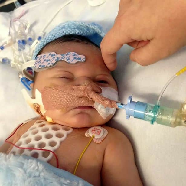 miracle baby smiles after surviving open heart surgery at just four