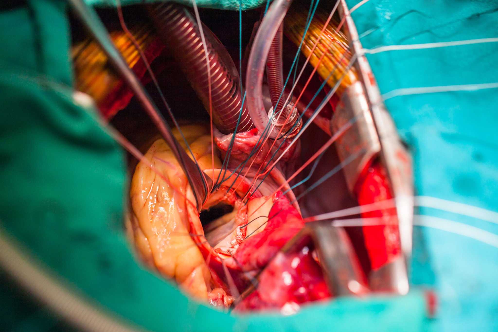 Mitral valve repair: minimally invasive heart surgery vs ...
