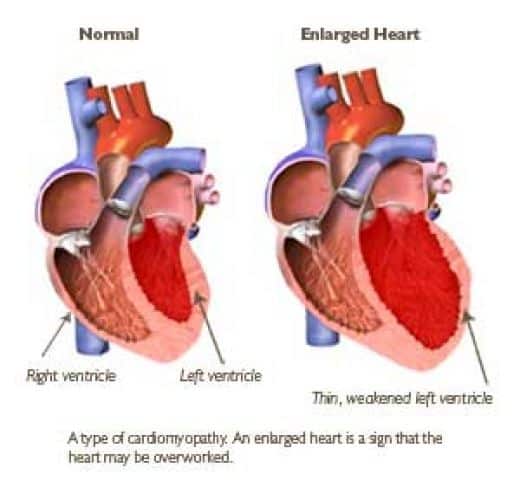 Myocardial infarction condition known congestive heart failure ...