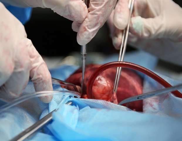 Patients can be discharged 3 days after open heart surgery without ...
