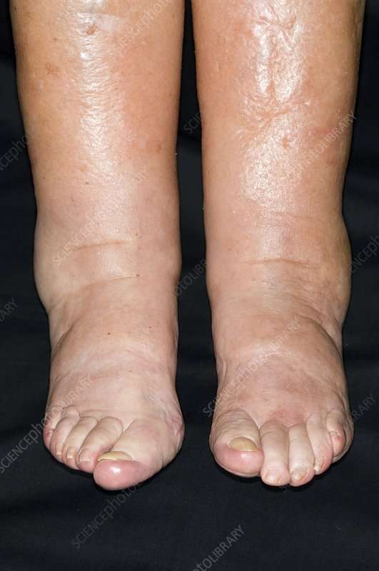 Pictures Of Swollen Ankles Due To Congestive Heart Failure