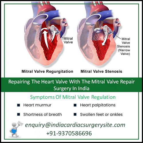Repairing The Heart Valve With The Mitral Valve Repair Surgery In India ...