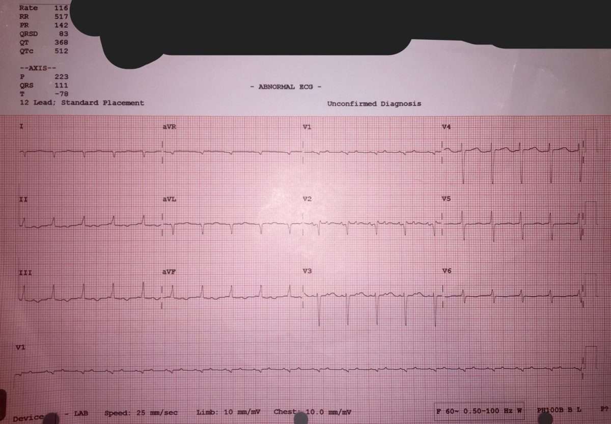 Right side congestive heart failure on ECG