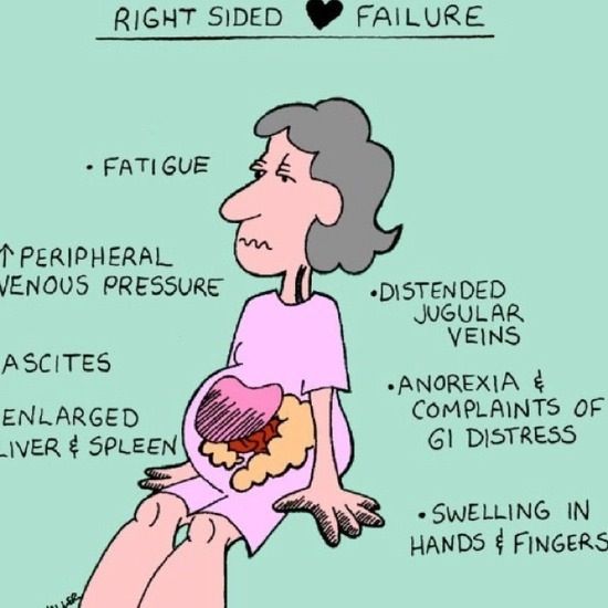 right sided heart failure (also, swelling of the ankles and extremities ...