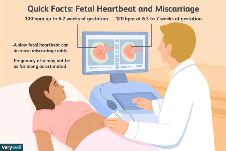 Risk of Miscarriage With Slow Fetal Heartbeat