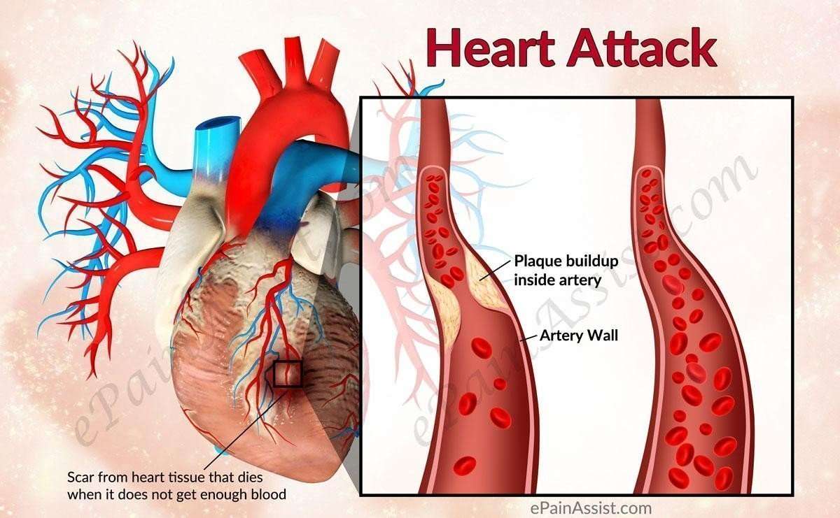 The Link Between Heart Disease and Heart Attack