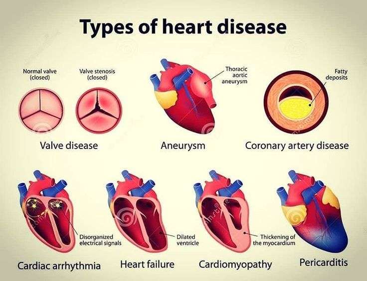 There are many types of heart disease that affect ...