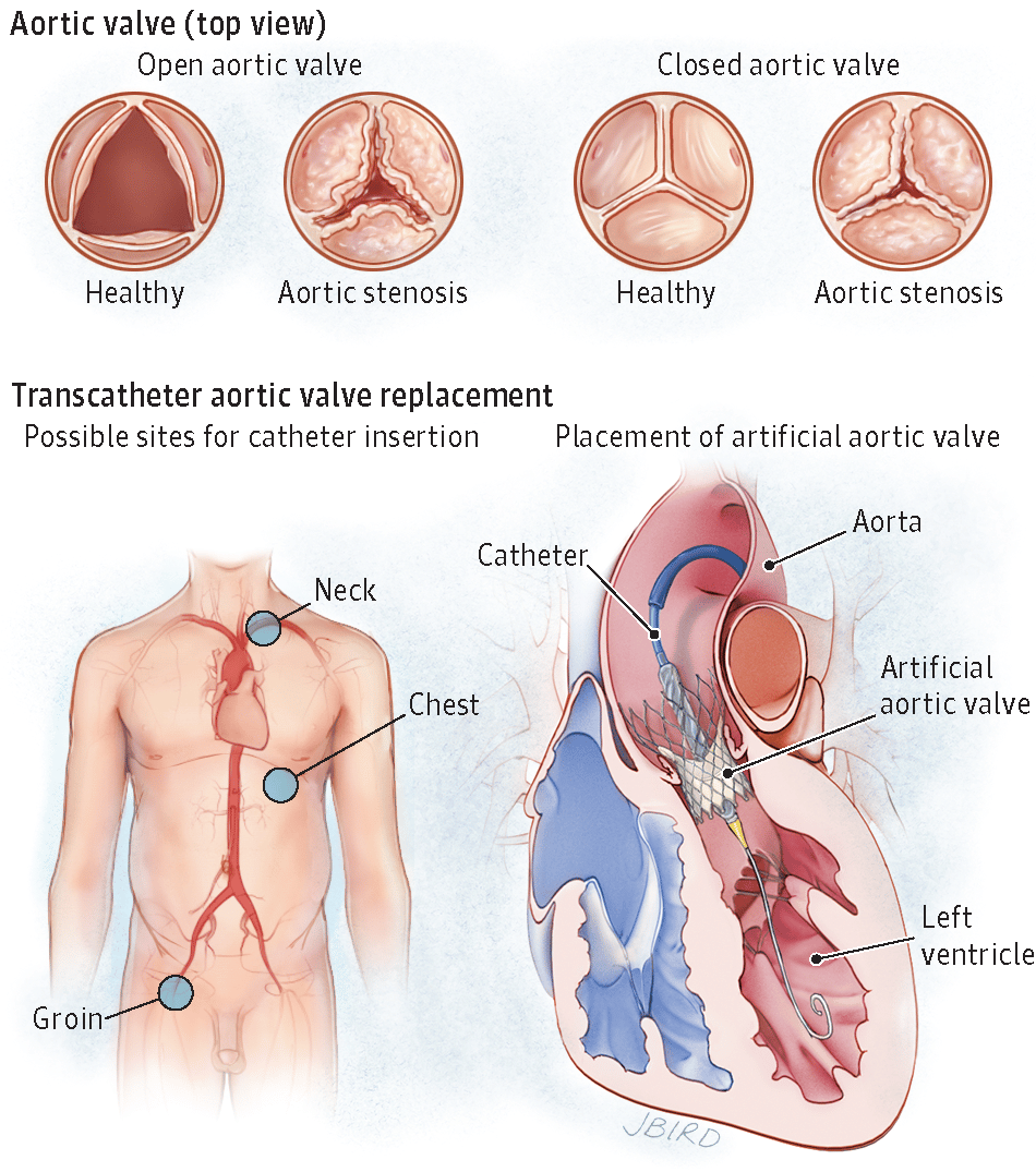 Transcatheter Aortic Valve Replacement. JAMA. 2014 312(19):2059. doi:10 ...