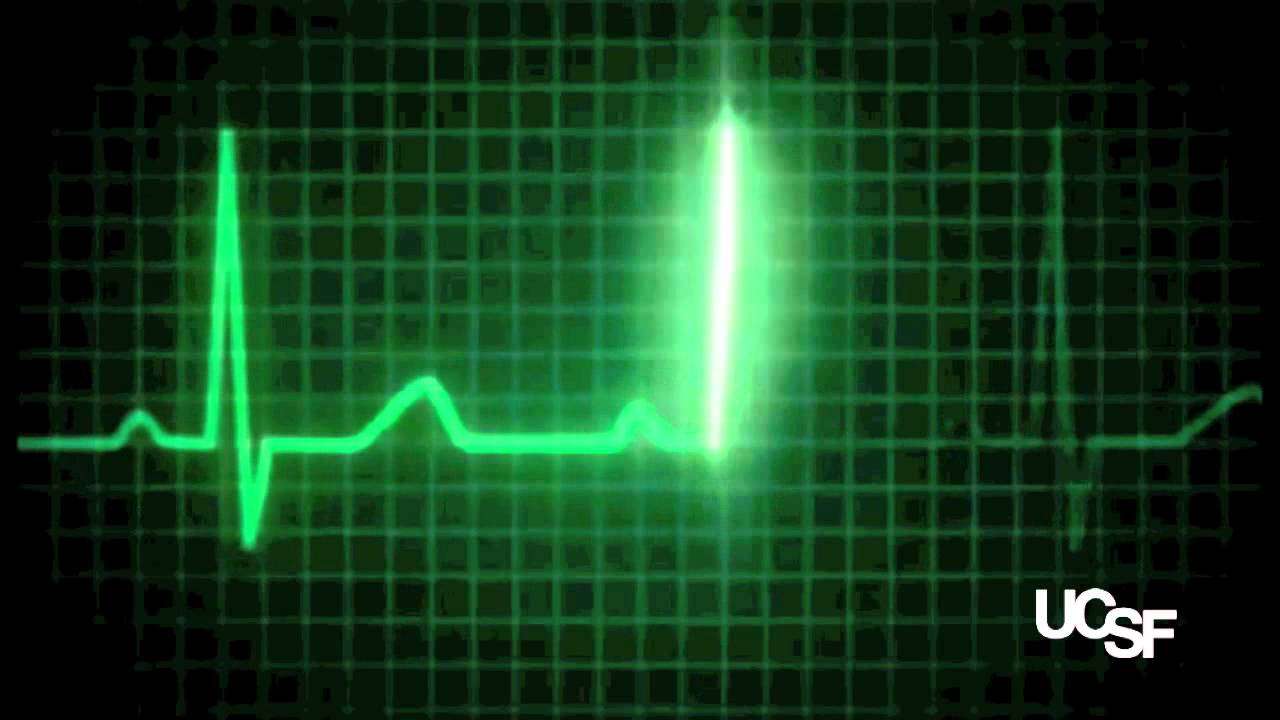 UCSF Researchers Find EKG Can Help Predict Heart Attacks ...