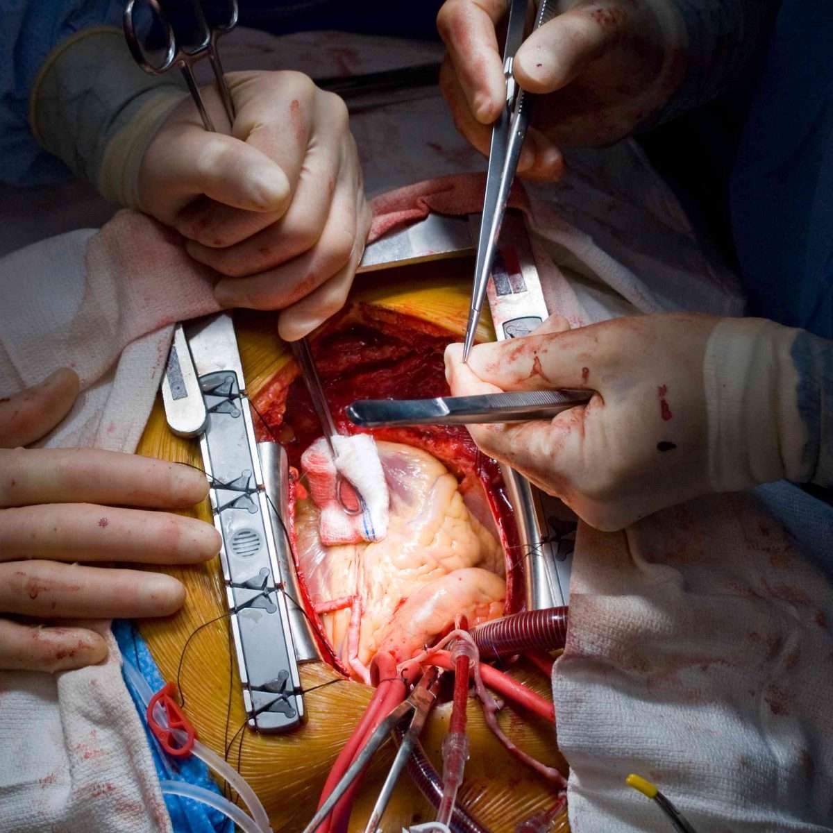 Vascular Bypass Graft Surgery: Overview
