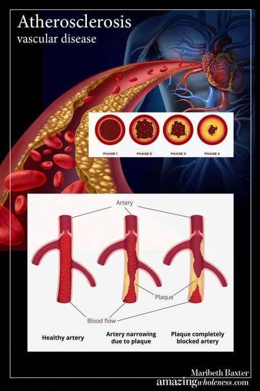 Vascular Health  Arteriosclerosis / Atherosclerosis # ...