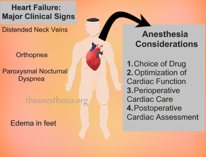 What is Congestive Heart Failure?. Anesthesia ...