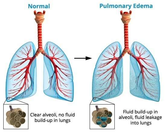 What is pulmonary edema disease?