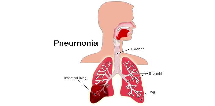 What is the difference between Pneumonia and Congestive heart ...