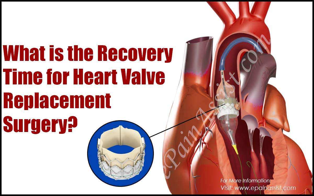 What is the Recovery Time for Heart Valve Replacement Surgery?