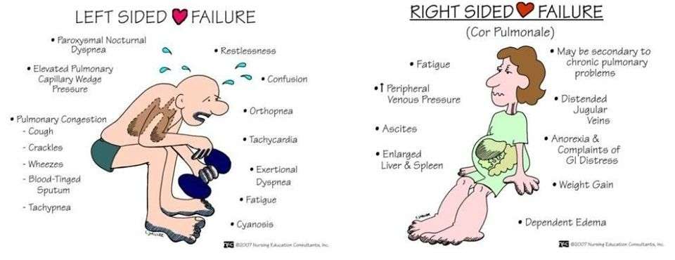 Your daily doze of mnemonics: Left and right sided heart failure (Image ...